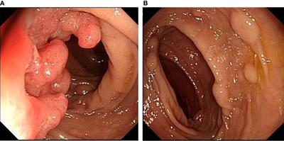 Case report: Coexistence of sigmoid tumor with unusual pathological features and multiple colorectal neuroendocrine tumors with lymph node metastases